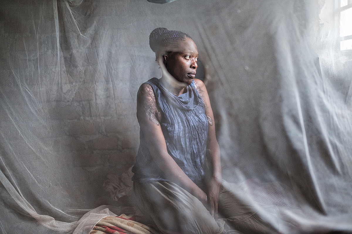 Nalumu / acid attack survivor
