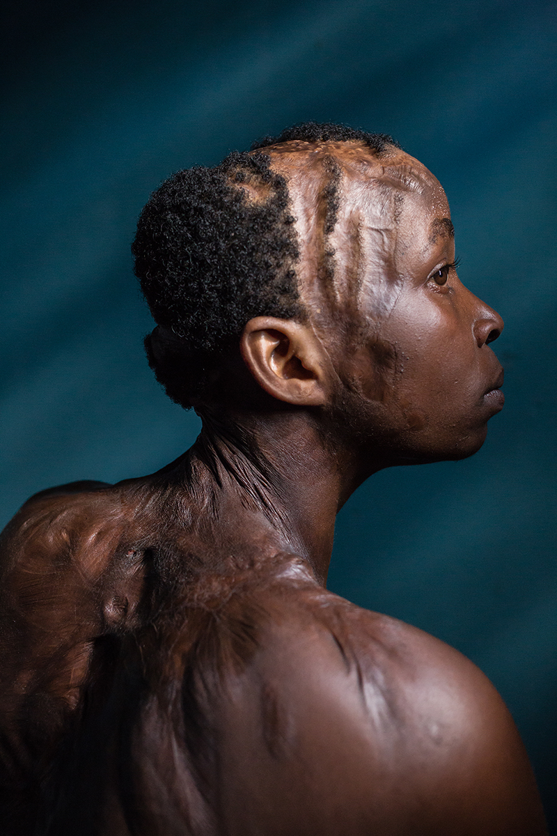 Lynette, acid attack survivor