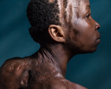 Lynette, acid attack survivor